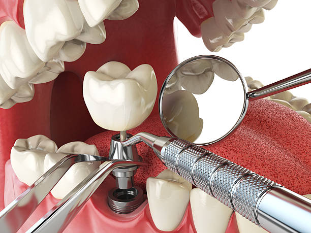 Best Emergency Dental Care for Broken or Chipped Teeth in Corralitos, CA
